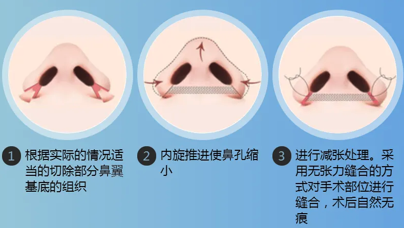 韩国缩鼻翼鼻头费用