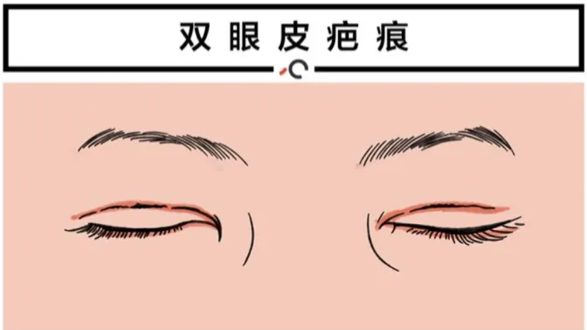 双眼皮疤痕修复手术图示