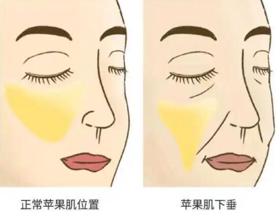 中面部苹果肌下垂怎么改善