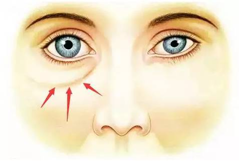 告知外切眼袋失败多久能做二次手术及术后需要注意事项有哪些?