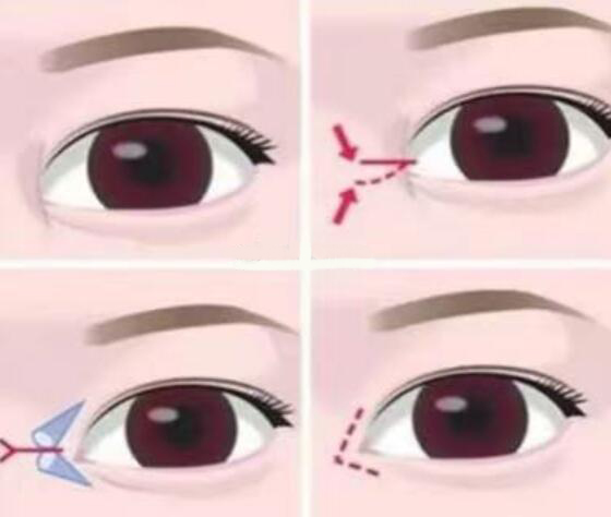 韩国清潭first整形外科介绍开眼角后留下的白色疤痕能自动消退吗？
