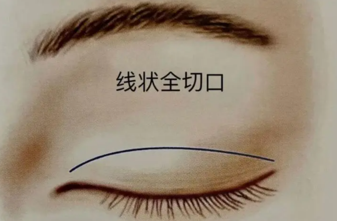 双眼皮手术