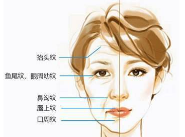 小切口除皱手术价格不贵不说,小切口除皱恢复期也没多久附照片