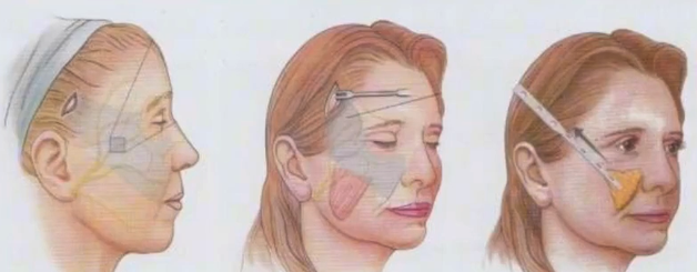 面部拉皮手术