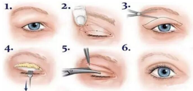 韩国双眼皮修复手术