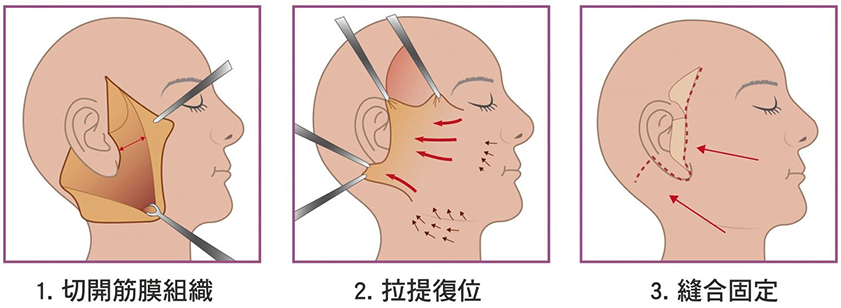 面部除皱术价格