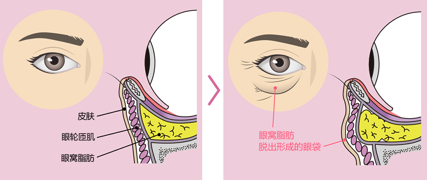 35岁割眼袋加眶隔释放到底能管多久呀