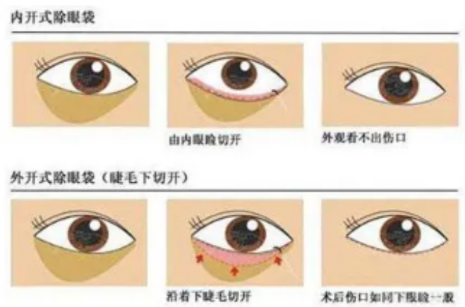 祛眼袋切口接近睫毛会外翻吗？疤痕会明显吗？不会外翻并且疤痕不明显