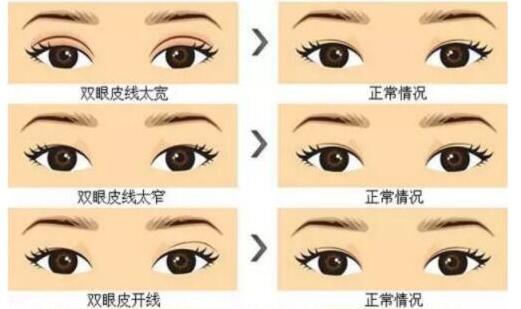 双眼皮割深了可以改浅吗