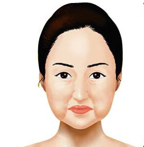 脸松垮可以做筋膜悬吊吗?适合这些人群做,且术后不会两边脸不一样