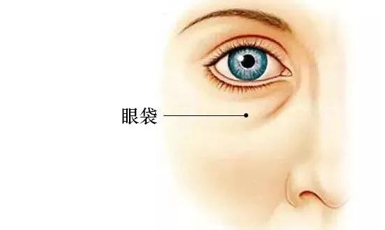 50多岁大眼袋能消除,50多岁较快去眼袋的方法有外切眼袋手术等
