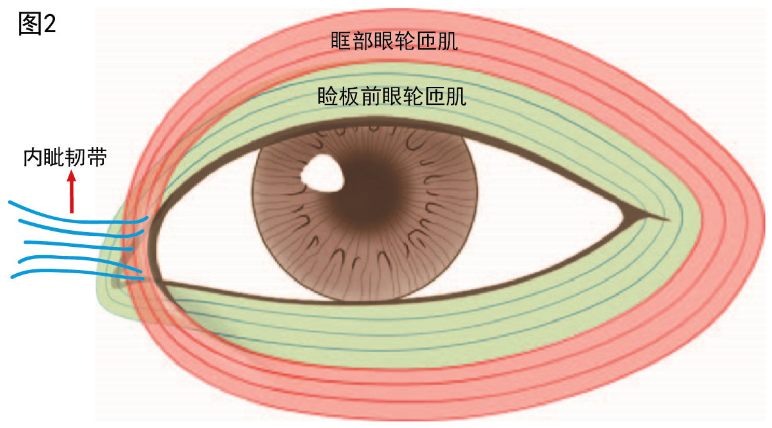 内眦赘皮开眼角会留疤吗