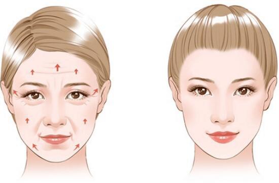 小切口面部提升术适合多少岁