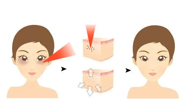 激光去眼袋全过程