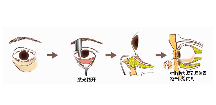 激光去眼袋手术全过程操作如何