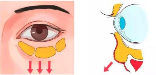失败眼袋术后几个月修复才能好起来