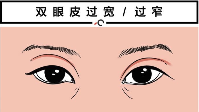 去韩国修复双眼皮的医院哪家好？推荐韩国清潭first整形外科的多